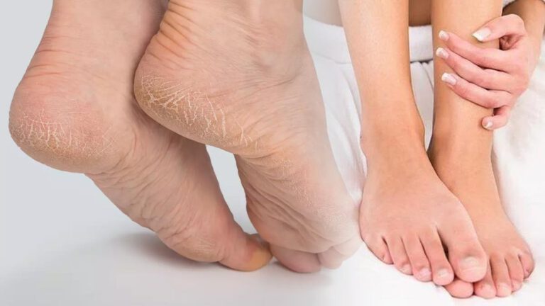 Pieds secs et crevassés  quelles sont les causes, les symptômes et les solutions 